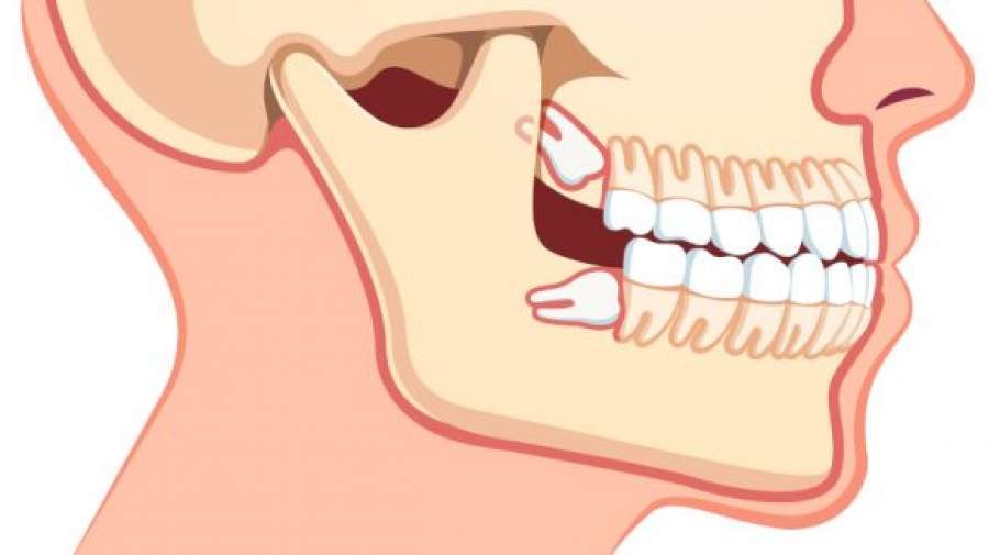 بررسی دندان‌های عقل