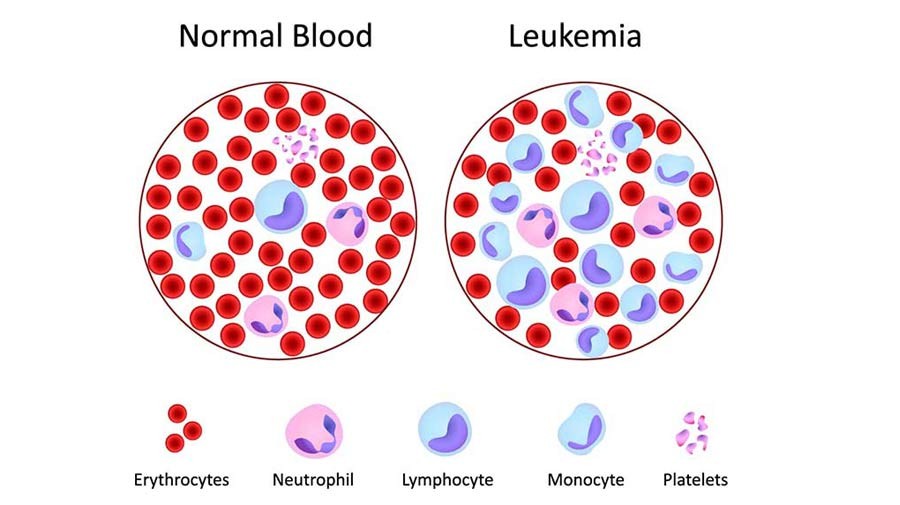 سرطان خون (LEUKEMIA) چيست؟