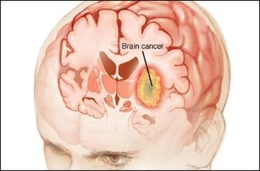 تشخیص سرطان مغز ظرف 30 دقیقه