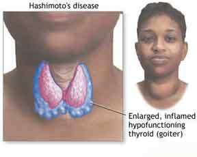 التهاب غده تيروييد(هاشيموتو) چیست؟