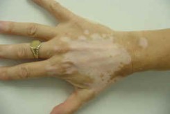 آشنایی با بیماری ویتیلیگو: Vitiligo