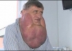 تصاویر تومور 6 کیلویی در صورت یک مرد