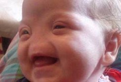 نوزادی که بینی ندارد + عکس