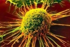 سرطان چگونه می‌آید/ آشنایی با بیماری «تومور دوردست»