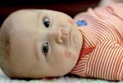 5 علت اگزماي نوزادي