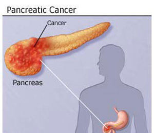 علائم سرطان پانکراس را بشناسید!