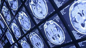 پنج واقعیت در مورد تومورهای مغزی