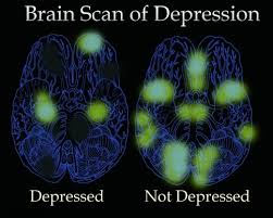 جایگاه افسردگی در مغز کشف شد