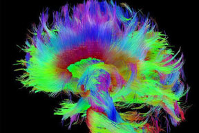 درمان جدیدی برای بیماران در کما/ کشف جایگاه خودآگاه در مغز