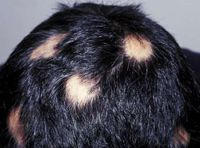 ریزش موی سکه‌ ای از تشخیص تا درمان