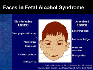 افزایش شمار کودکان مبتلا به «سندروم جنین الکلی»