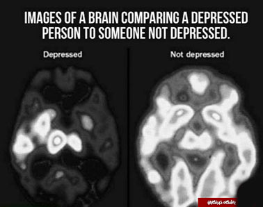 عکس/ عملکرد مغز در هنگام افسردگی