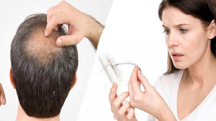 9 دلیل ریزش مو و روش های درمان آنها