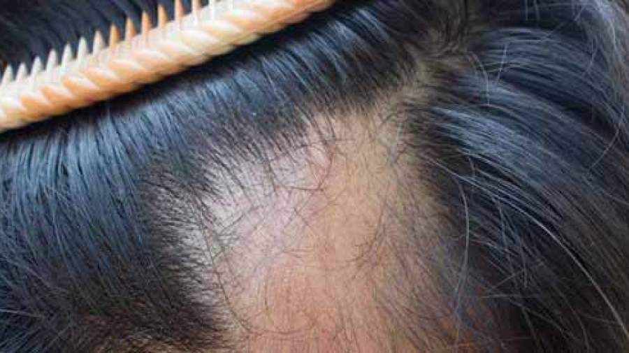 آیا روش‌های درمان ریزش‌ مو مؤثرند؟