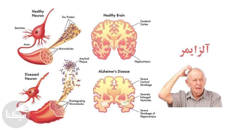 پنج علامت بیماری زوال عقل/ اصول مراقبت از مبتلایان به آلزایمر در خانه