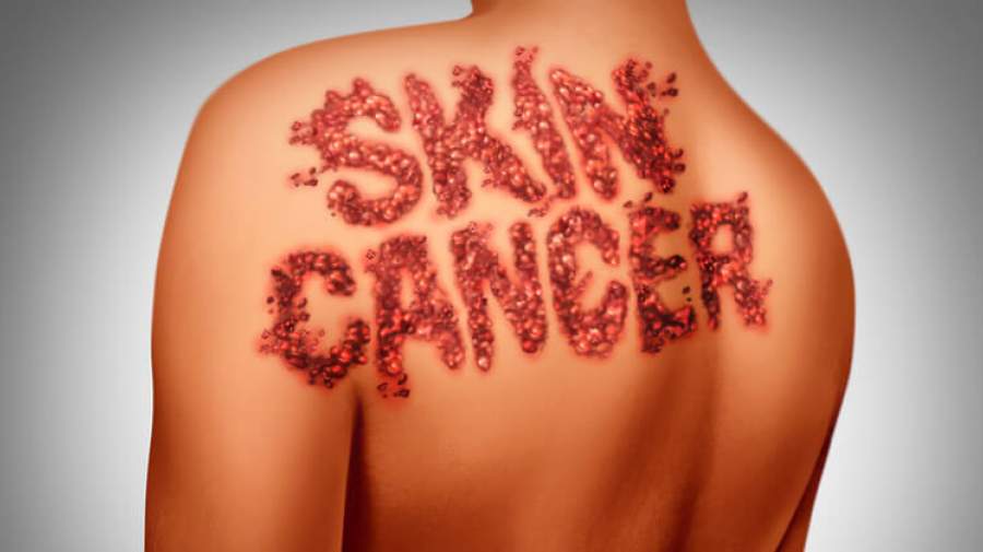 سرطان پوست از کجا شروع می شود؟