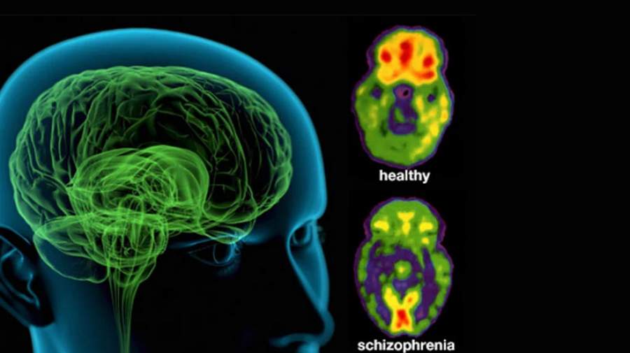 ساختار مغزی در افراد اسکیزوفرن با هوش بالا