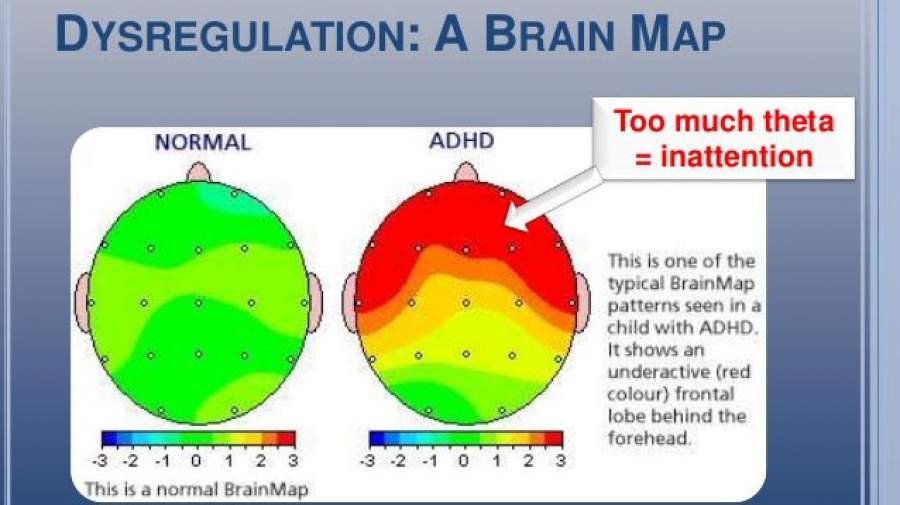 روش های تشخیص اختلال نارسایی توجه-بیش فعالی ADHD