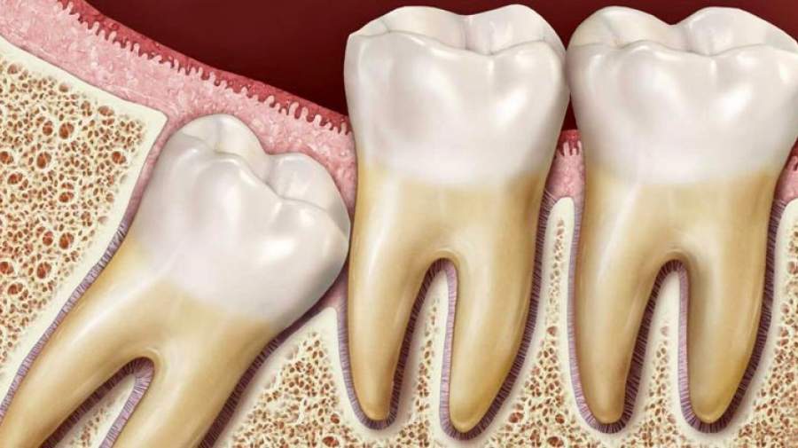 کشیدن دندان عقل موجب بهبود عملکرد چشایی می‌شود!