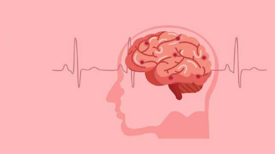 خطر سکته مغزی در زنان پایین ۳۵ سال بیشتر از مردان است