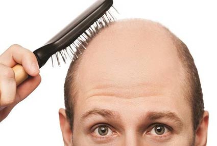 تفاوت های ریزش مو در زنان و مردان+راه های درمان