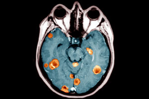 درمان سرطان مغز با سلول های چربی