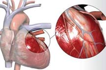 ۸۰درصد بيماران دچار سکته قلبي با سلول هاي بنيادي بهبود مي يابند