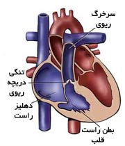 چرا دریچه ریوی قلب تنگ می شود؟ + راه های تشخیص