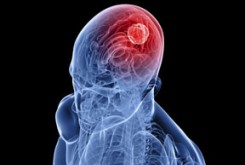 چرا تومور مغزی در مردان بیشتر است؟