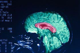 مغز مردان زودتر از زنان پیر می‌شود