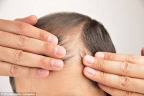 راهی جدید برای درمان ریزش مو
