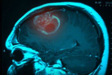دانشمندان مدعی کشف علت اصلی ابتلا به سرطان مغز شدند