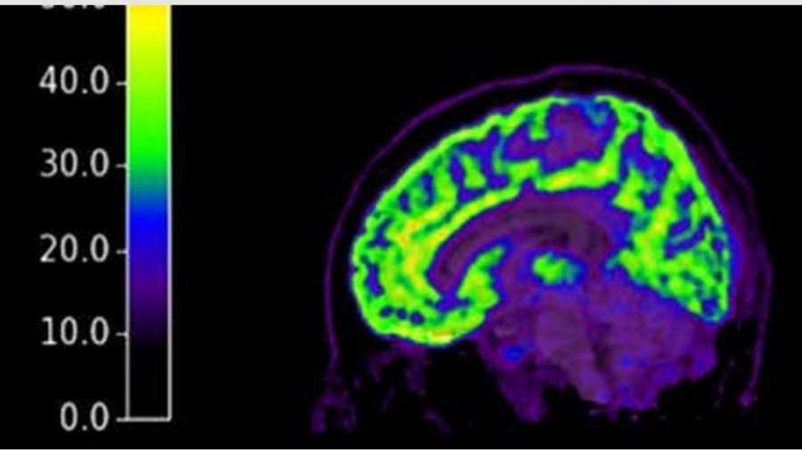 کشف اختلالات خاص مغزی در سر افراد قاتل