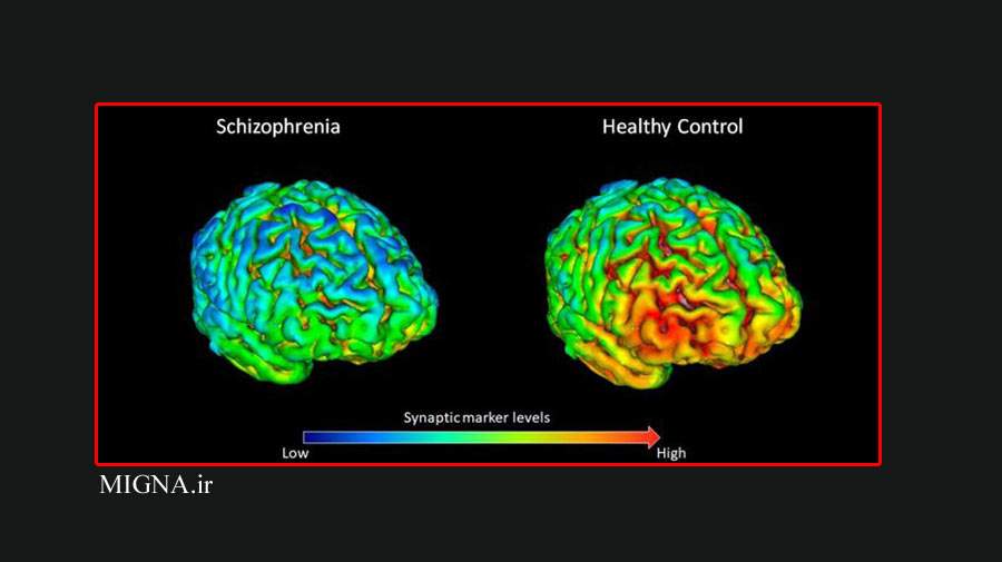 بررسی بهتر مغز بیماران اسکیزوفرنیک با روش تصویربرداری جدید