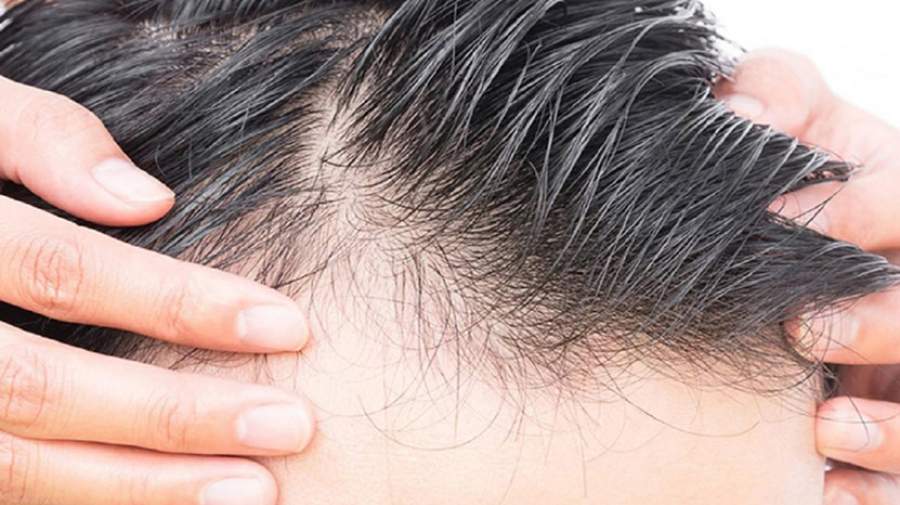 توقف ریزش مو با مصرف این ویتامین