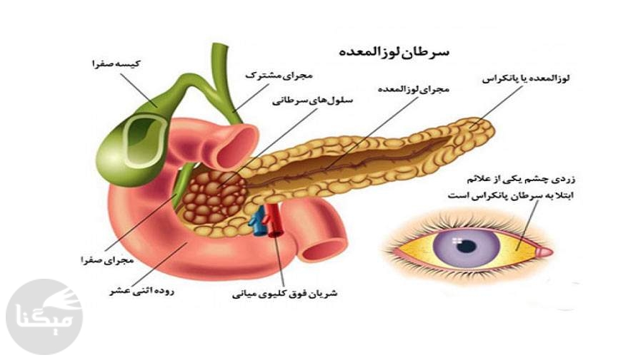 علائم سرطان پانکراس را بشناسیم/ هفتمین سرطان کشنده در ایران