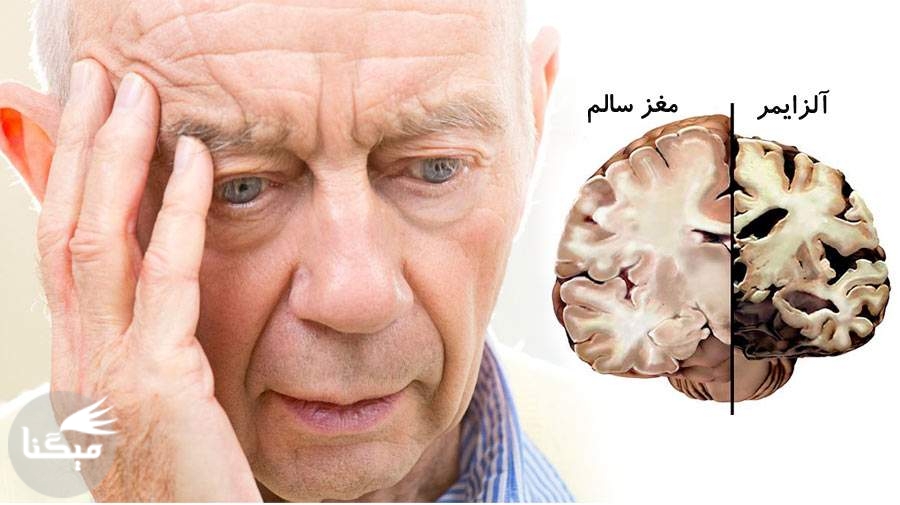 رابطه ‌میزان خواب و بیماری آلزایمر