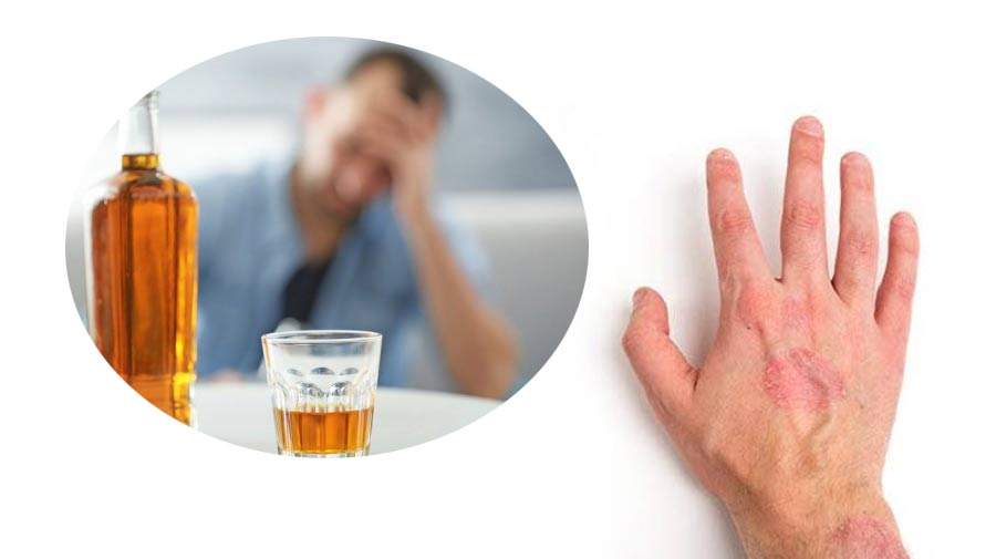 ارتباط مصرف مشروبات الکلی با افزایش ریسک ابتلا به سرطان