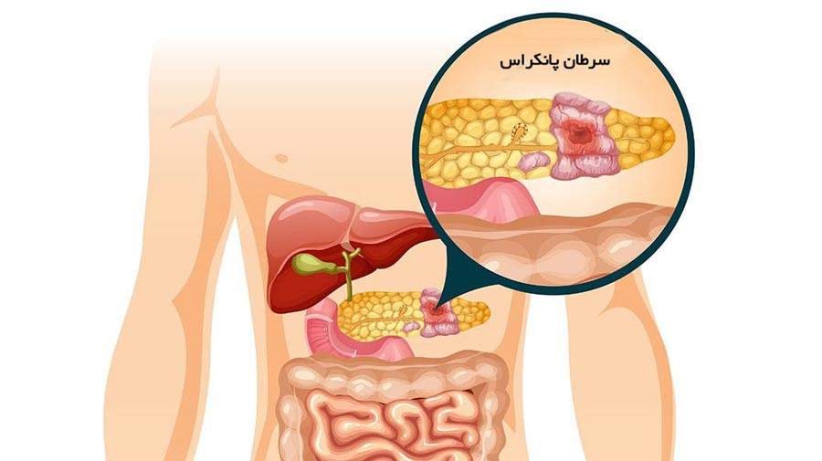 یک نشانه ابتلا به سرطان پانکراس پس از غذا خوردن یا دراز کشیدن