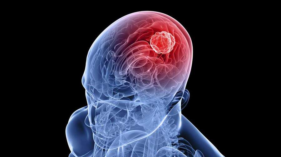 نشانه‌ها، علائم و راه‌های درمان تومور مغزی چیست؟